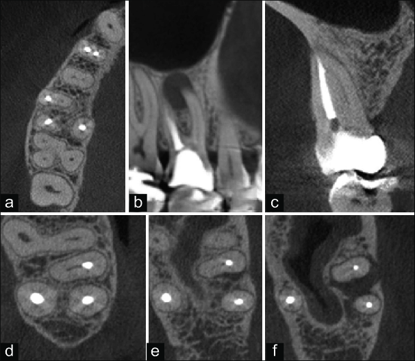 Root Canal Treatment