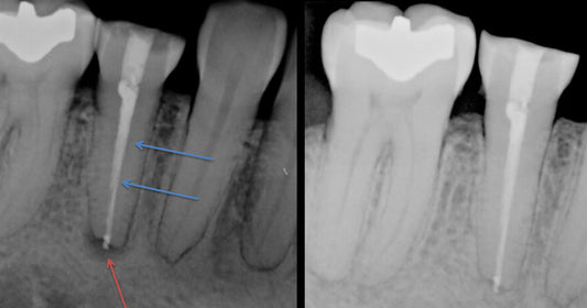 In-Practice: Does My Patient Need a Root Canal?
